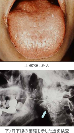 上)乾燥した舌　下)耳下腺の萎縮を示した造影検査