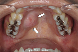 口蓋の多形腺腫