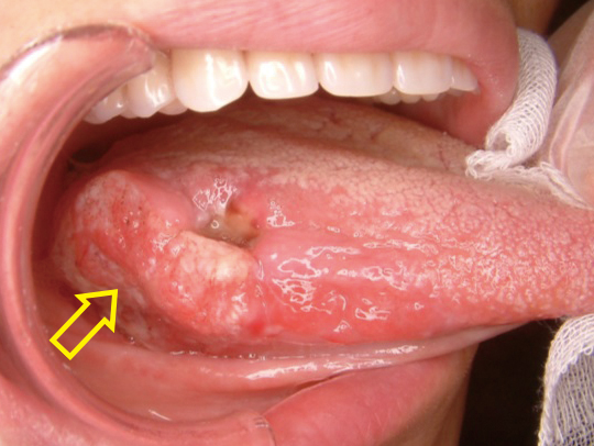 舌ガン(潰瘍型)