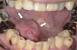 舌下腺がん(腺様嚢胞癌)