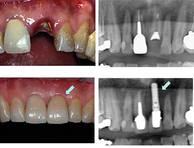 デンタルインプラント(人工歯根(じんこうしこん))