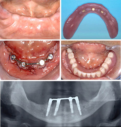 デンタルインプラント(人工歯根(じんこうしこん))