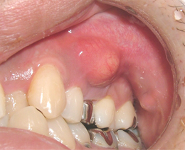 歯槽膿瘍