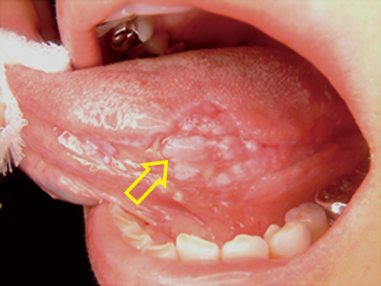 舌ガン(白斑型)