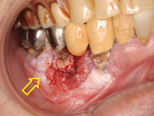 下顎歯肉がん