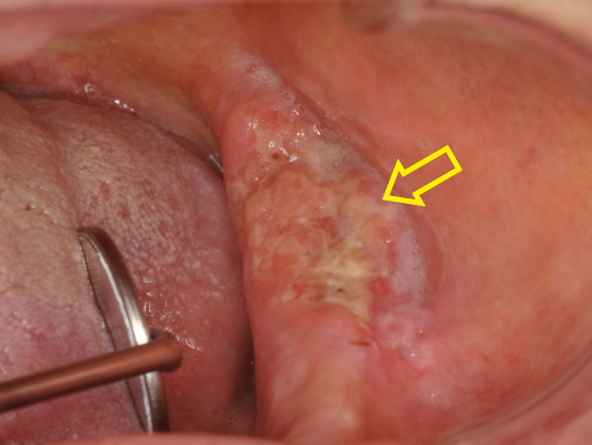 下顎歯肉がん
