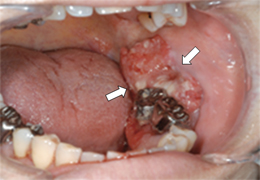 歯肉がん(下顎)