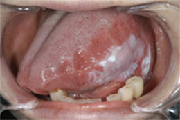 白板症（引用：公益社団法人 日本口腔外科学会 口腔外科相談室）