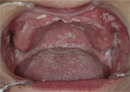 中 水疱 の 口 唇の中に透明な水ぶくれができる原因／痛くない場合は何なの？