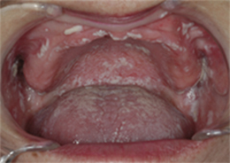 口腔粘膜疾患 口腔外科相談室 日本口腔外科学会