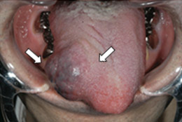 血管腫(舌)