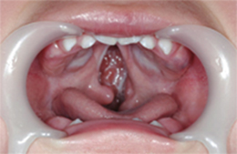 口唇裂口蓋裂などの先天異常 口腔外科相談室 日本口腔外科学会