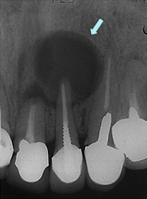 歯根 嚢胞 放置 し て も 大丈夫